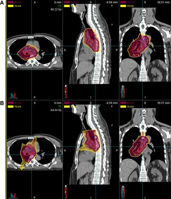 Preliminary Safety and Efficacy of Proton Plus Carbon-Ion Radiotherapy With Concurrent Chemotherapy in Limited-Stage Small Cell Lung Cancer
